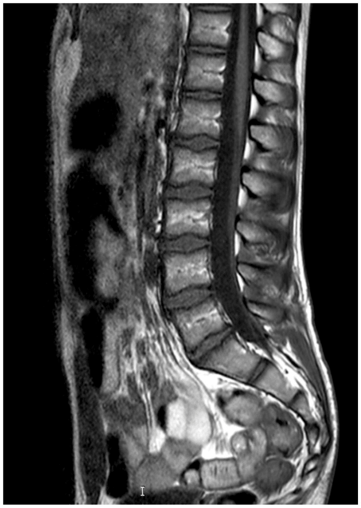 Sagittal MRI showing the conus medullaris at the L1-L2 level without tethered cord syndrome