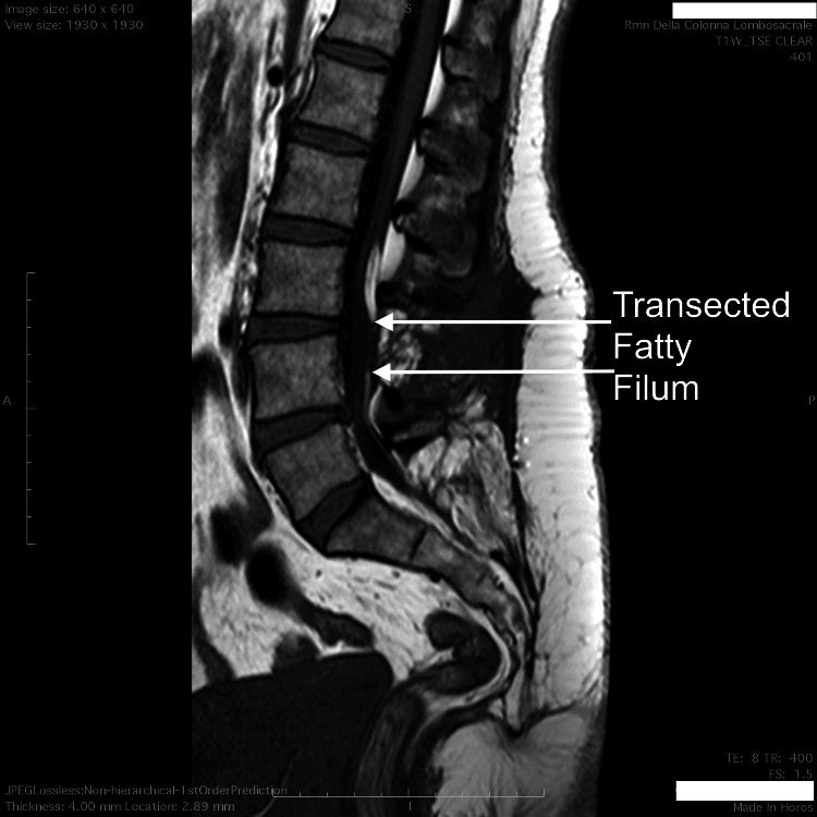 Sagittal lumbar MRI after fatty filum sectioning showing the conus remaining low while the patient became asymptomatic