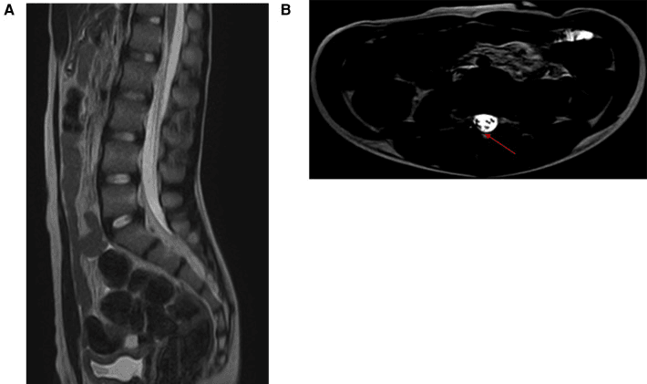 Prone lumbosacral MRI showing the thickened filum terminale remaining dorsal instead of falling anteriorly
