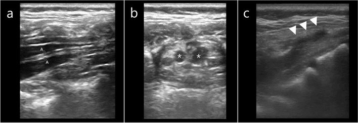 Spinal ultrasound images showing a thickened filum terminale surrounded by hyperechoic fatty tissue and a Tarlov cyst