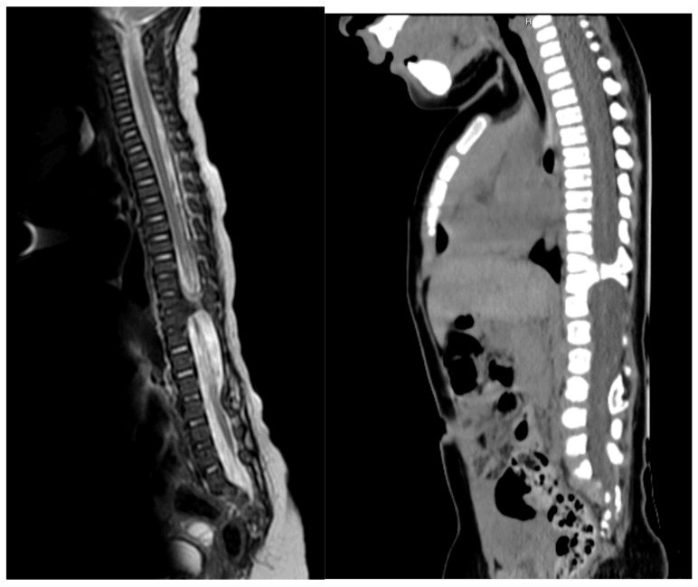 Sagittal T2 MRI and CT showing a type I split cord malformation with a vertebral bony spur