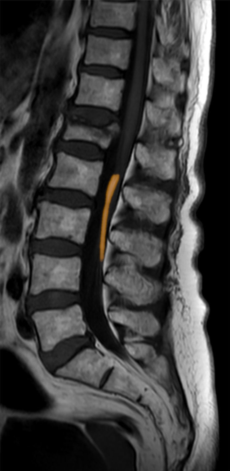 Annotated sagittal T1 MRI of the lumbosacral spine with the fatty filum terminale highlighted in orange in the distal spinal canal