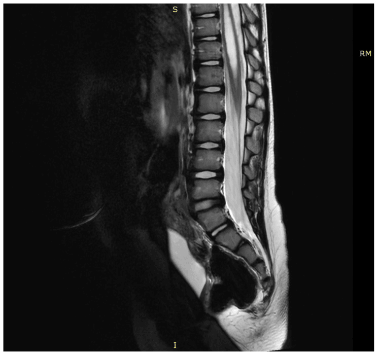 Sagittal T2 MRI showing a low-lying conus with syringomyelia caused by a tight filum terminale