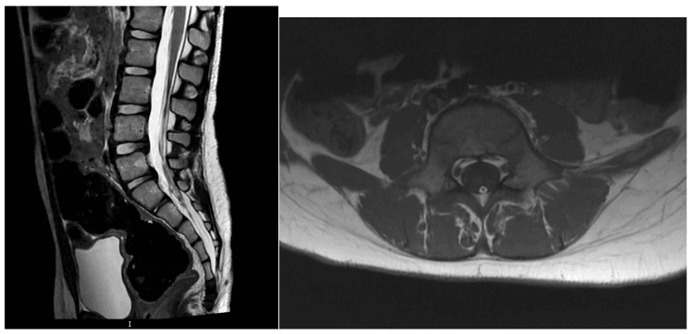 Sagittal T2 and axial T1 MRI showing a tight, fatty filum terminale causing tethered cord syndrome