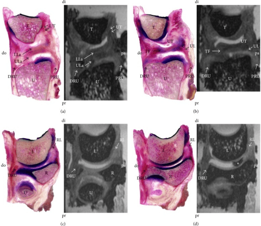 Open-access plastination and MRI correlation of the triangular fibrocartilage complex