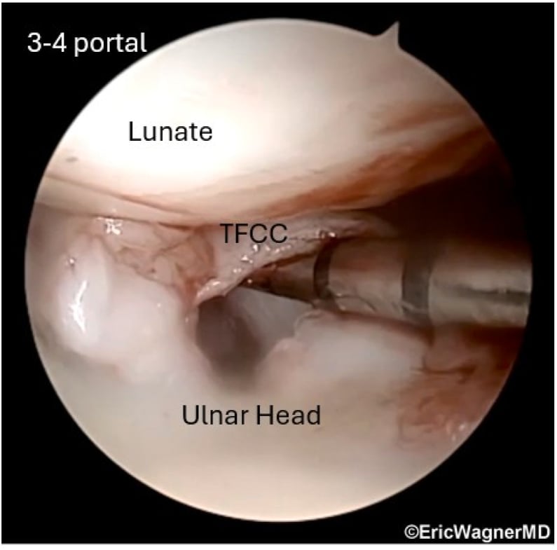 Arthroscopic positive hook test from the 3-4 portal, the probe lifting the TFCC from the ulnar head, with lunate, TFCC and ulnar head labelled