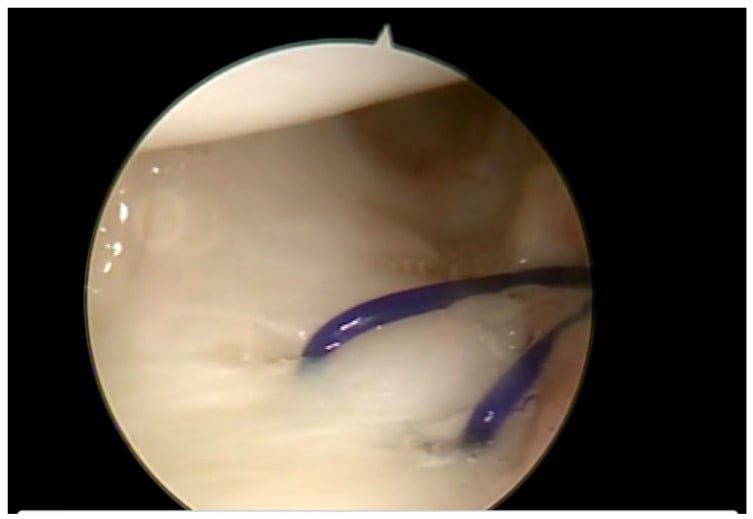 Arthroscopic view of a peripheral TFCC repair suture