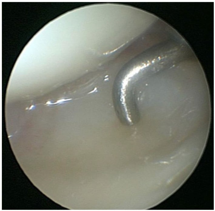 Arthroscopic view of a hooked probe pressing on the TFCC for the trampoline test