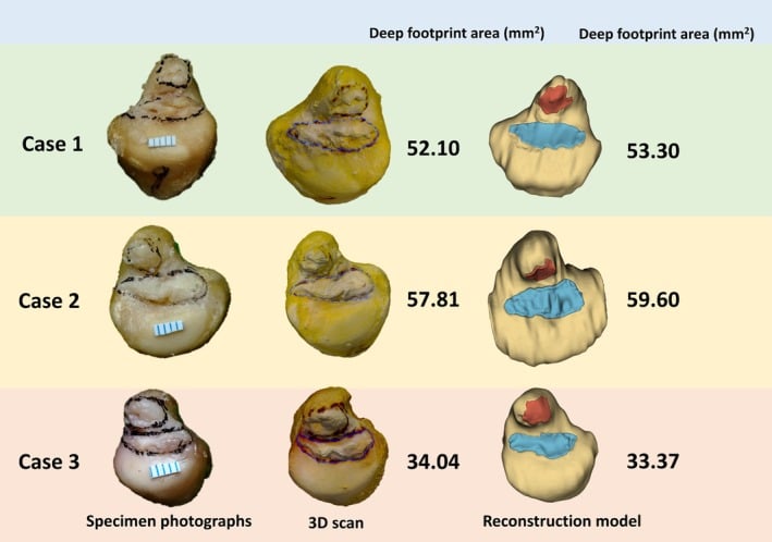 Three ulnar-head specimens shown as photograph, 3D scan and reconstruction model, with the deep foveal footprint area printed beside each