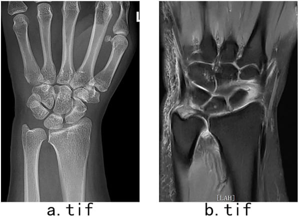 PA wrist radiograph (a) and coronal MRI (b) from a case of degenerative central TFCC perforation