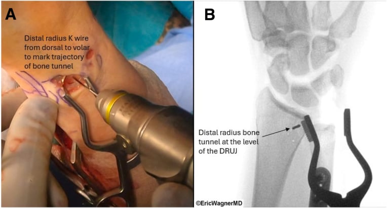 Operative photograph of a dorsal-to-volar distal radius K-wire marking the tunnel trajectory (A) and fluoroscopy of the distal radius bone tunnel at the level of the DRUJ (B)