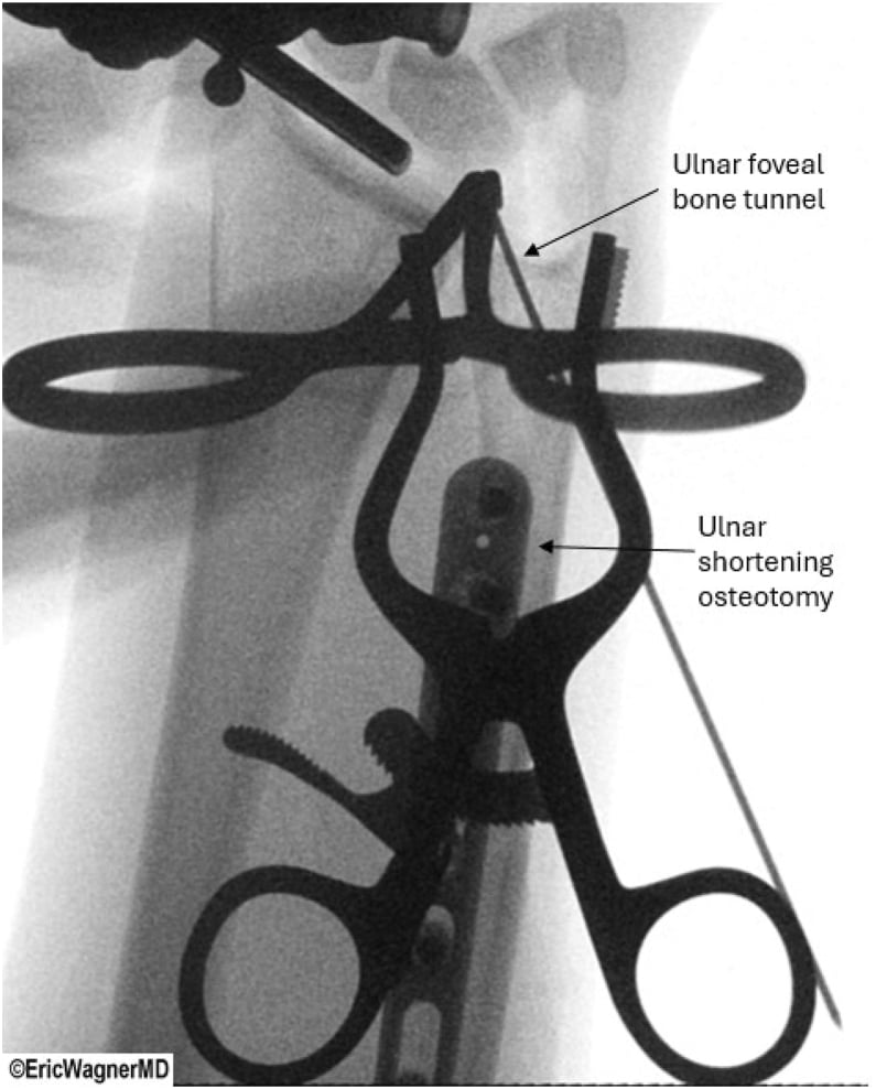 Fluoroscopy of combined TFCC reconstruction and ulnar shortening osteotomy, with the ulnar foveal bone tunnel and the ulnar shortening osteotomy labelled