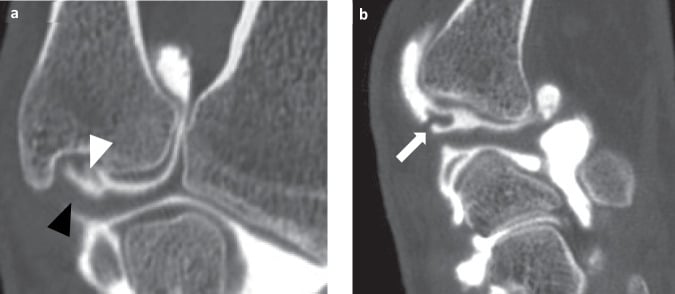 Coronal (a) and sagittal (b) arthro-CT of an isolated foveal TFCC tear, with arrowheads in panel a and an arrow in panel b