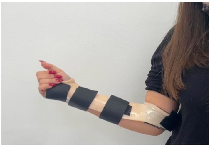 Forearm in a Munster splint extending from the hand past the elbow, with the elbow flexed