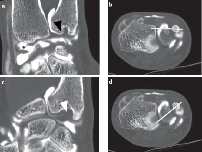 Arthro-CT of a partial dorsal foveal TFCC tear: two reformats with arrowheads (a, c) and the axial images carrying their reference lines (b, d), one of them an oblique radial-plane line