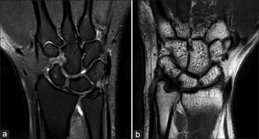 Open-access wrist MRI examples showing TFCC and DRUJ pathology