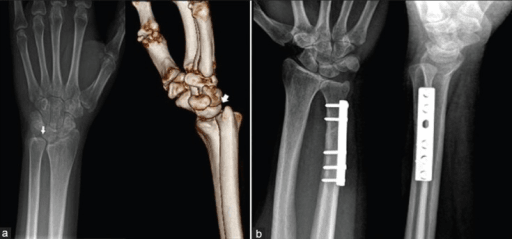 Open-access ulnar impaction and ulnar shortening clinical imaging sequence