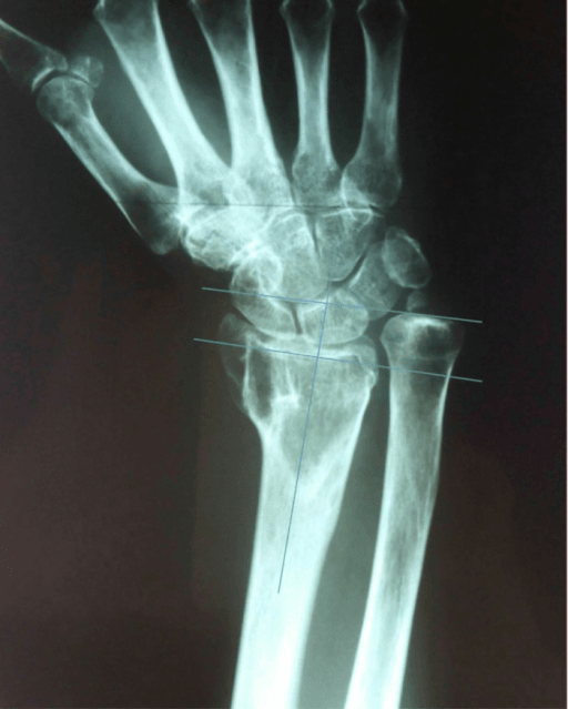 Open-access radiographic ulnar variance measurement example