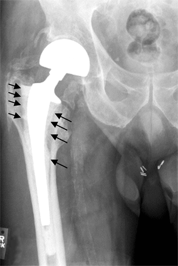 AP hip radiograph showing aseptic loosening of a total hip arthroplasty with radiolucent lines and osteolysis around the femoral stem.