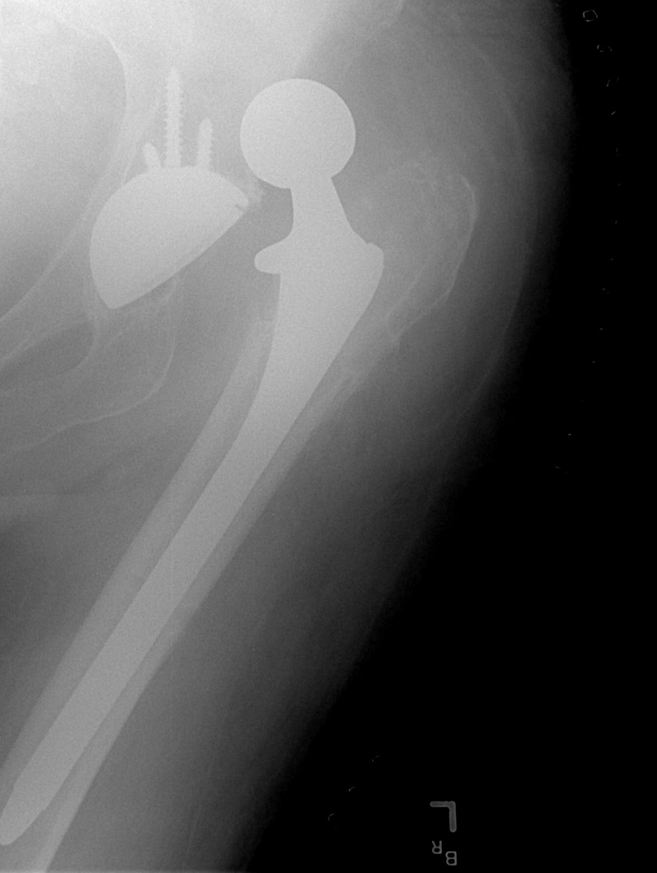 Radiograph of a dislocated total hip replacement with the prosthetic femoral head displaced out of the acetabular cup