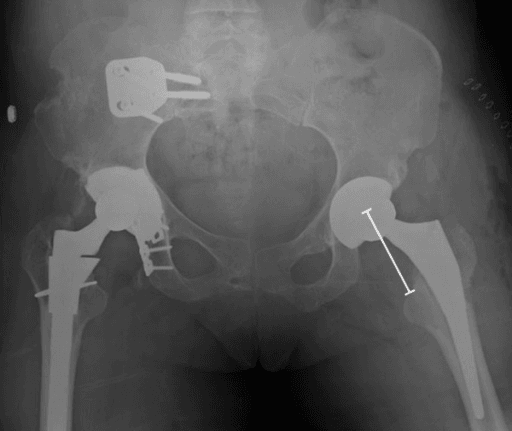 AP pelvic radiograph measuring the distance from femoral head centre of rotation to the lesser trochanter