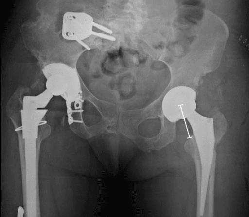 AP pelvic radiograph showing reduced distance from femoral head centre of rotation to the lesser trochanter after revision