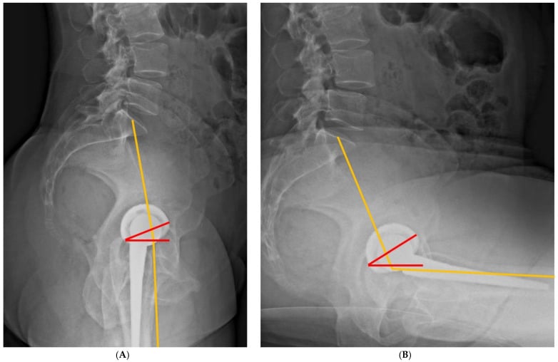 Standing and sitting lateral radiographs illustrating combined sagittal index measurement