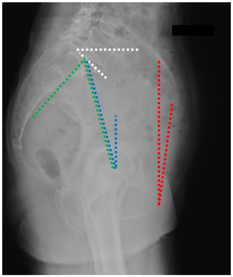 Lateral pelvic radiograph illustrating spinopelvic alignment parameters used in functional total hip arthroplasty planning