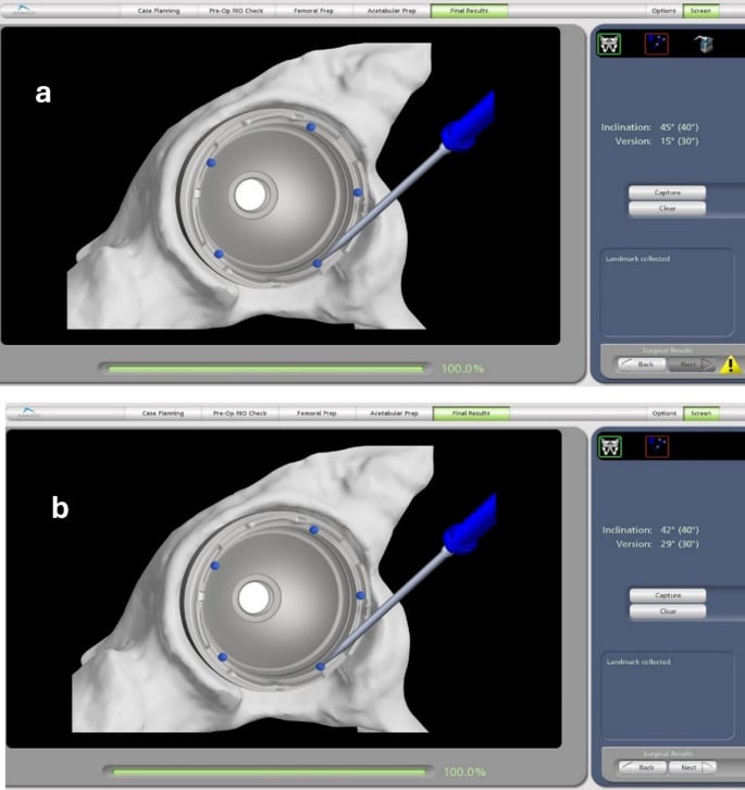 Intraoperative acquisition of reference points on total hip arthroplasty trial and definitive acetabular cups