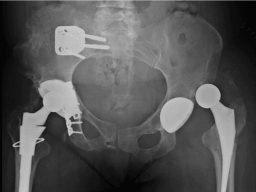 AP pelvis radiograph showing an anteriorly dislocated left total hip arthroplasty