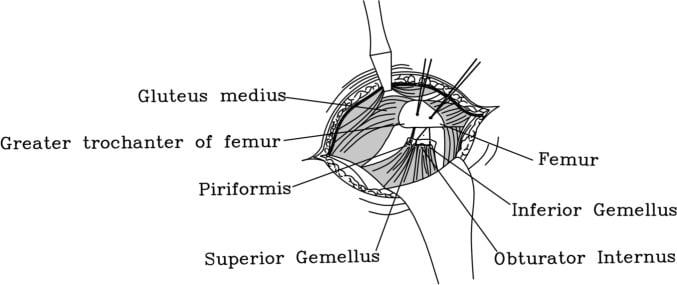 Posterior hip exposure showing the short external rotators and greater trochanter for tendon-to-bone repair