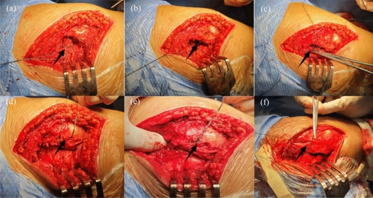 Operative sequence showing suturing of the posterior short external rotators and capsule