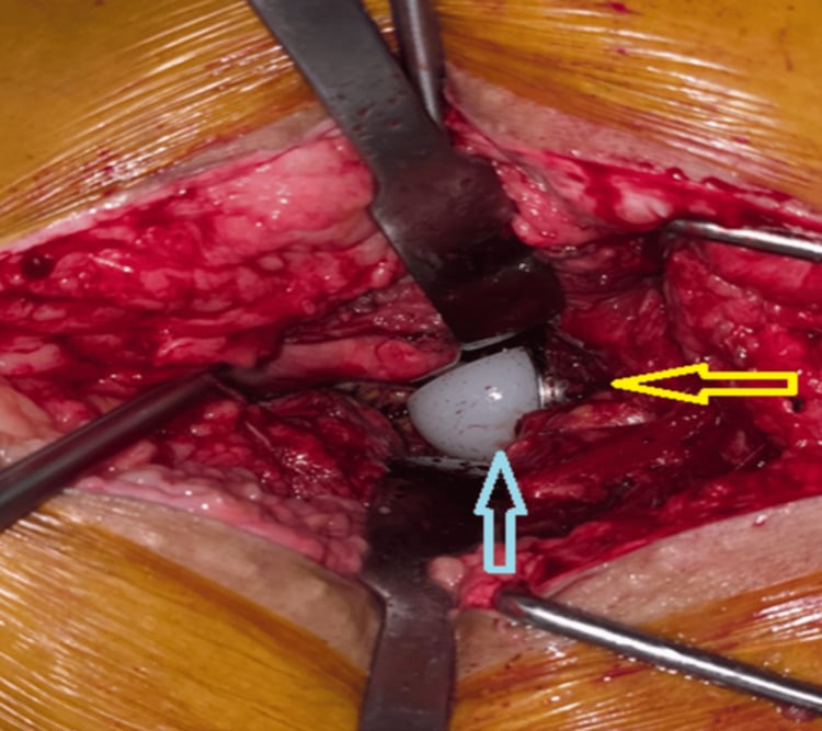 Intraoperative view of a dissociated polyethylene liner in dual-mobility total hip arthroplasty