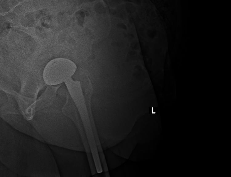 Lateral radiograph showing displacement of a femoral head prosthesis relative to the acetabular cup