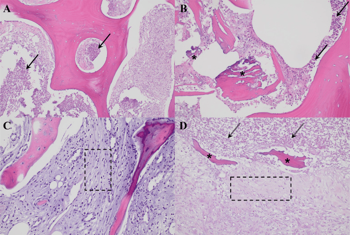 Histology showing acute and chronic osteomyelitis patterns in peri-implant hip bone