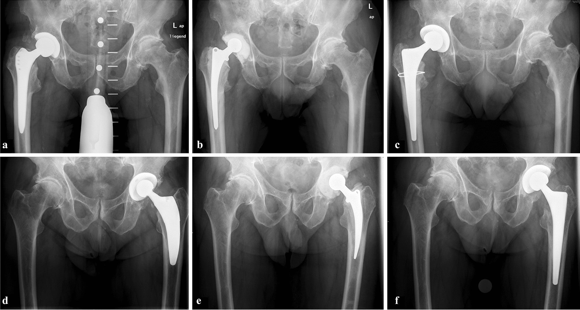 Six AP hip radiographs from two patients showing the two-stage revision sequence: prior to explantation, with an articulating antibiotic cement spacer in situ, and after reimplantation.