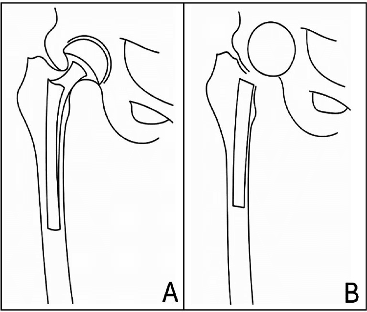 Line drawings comparing an articulating hip spacer (A) with a non-articulating spacer (B)