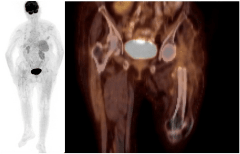 FDG PET-CT showing diffuse homogeneous periarticular uptake classified as non-suggestive of PJI