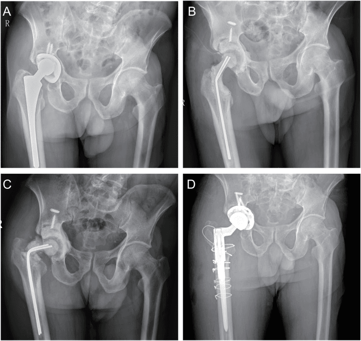 Serial AP pelvic radiographs showing early cement spacer fracture and later two-stage reconstruction