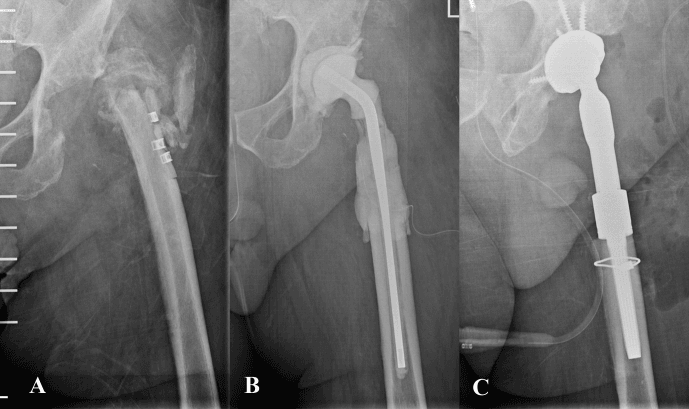 Serial hip radiographs showing chronic PJI osteomyelitis before and after wide proximal femoral resection and reconstruction