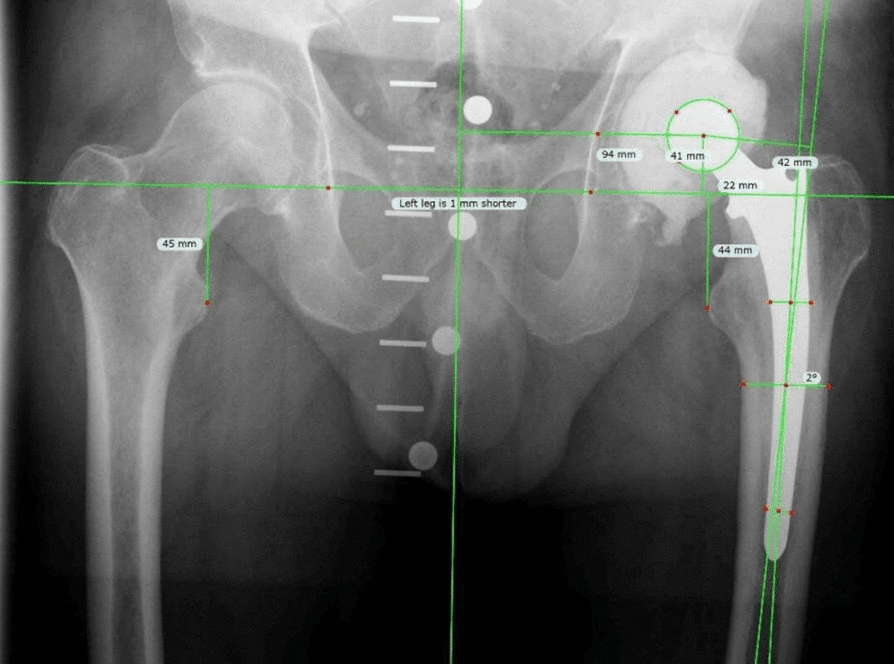 AP pelvis radiograph with measurements showing patient-specific offset and leg length after custom articulating spacer