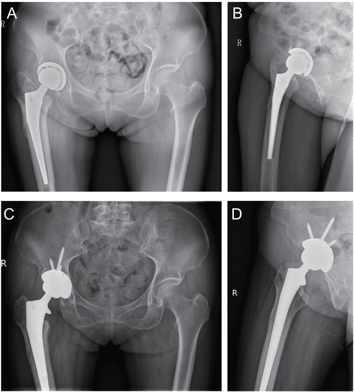 Preoperative and two-year postoperative AP and lateral radiographs after one-stage revision for chronic hip PJI