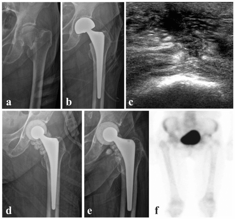 Serial radiographs ultrasound and bone scan showing partial two-stage hip PJI treatment with stem retention