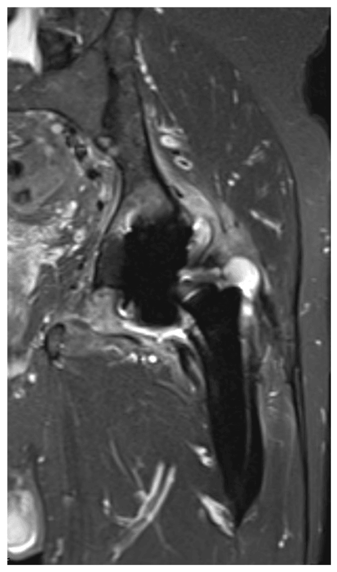 Coronal metal-artifact-reduced hip MRI showing effusion capsular enhancement muscle oedema and interface marrow oedema