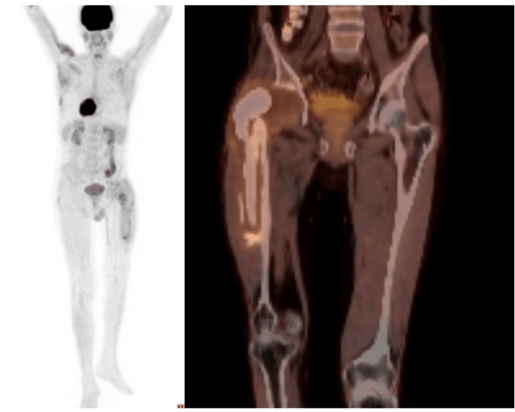 Whole-body FDG PET projection and coronal fused PET-CT showing focal uptake around a long-stemmed hip prosthesis