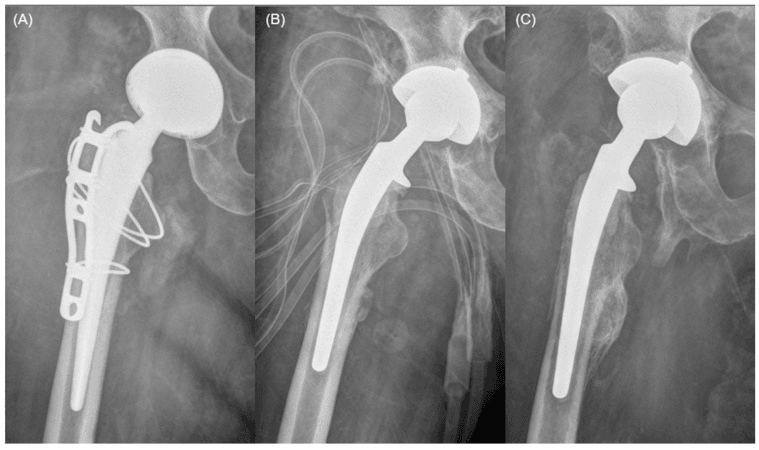 Serial AP hip radiographs showing long-term retention of a dual-mobility functional articulating spacer
