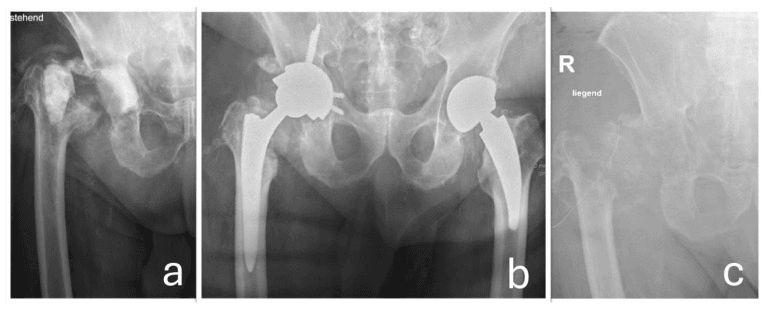 Serial radiographs showing static spacer delayed reimplantation and recurrent infection requiring re-explantation