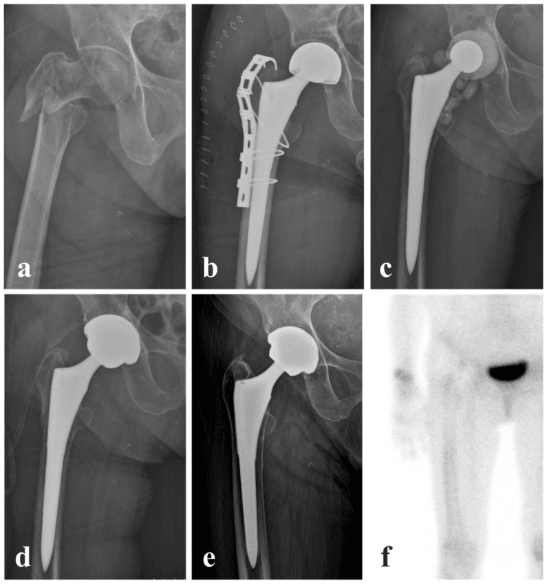 Serial hip radiographs and bone scan showing two-stage PJI revision with femoral stem retention