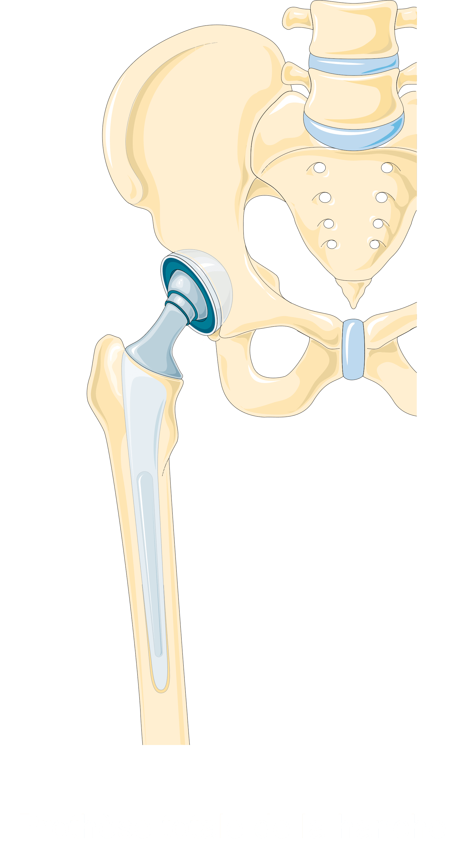 Illustration of a total hip replacement showing the acetabular cup, head and femoral stem.