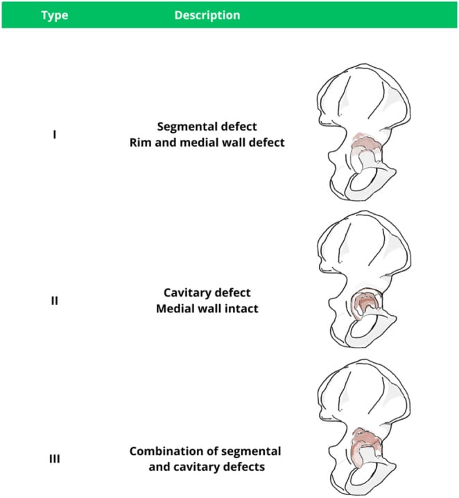 Schematic of the AAOS acetabular bone deficiency classification showing segmental, cavitary and combined defects
